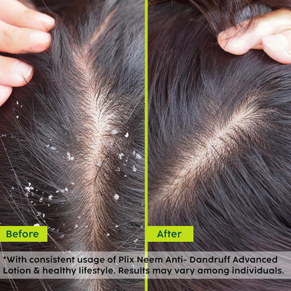 Plix Neem Anti-Dandruff Advanced Lotion Reduce Dandruff, Itching & Irritation Unisex (60ml)